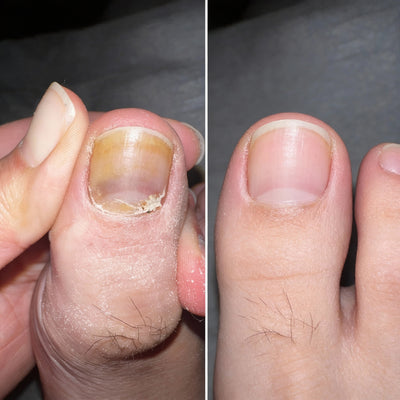 EPIDEX Fungal Nail Renewal Patches - Exclusive Offer