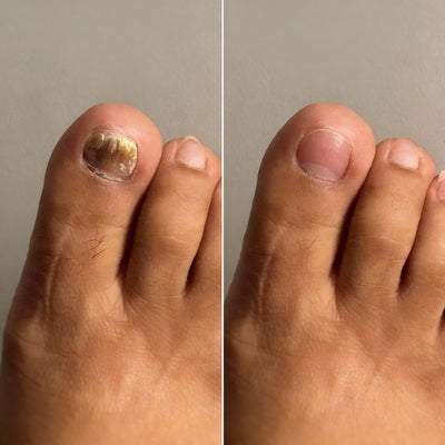 EPIDEX Fungal Nail Renewal Patches - Exclusive Offer