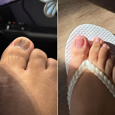 EPIDEX Fungal Nail Renewal Patches - Exclusive Offer